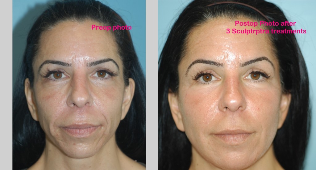 Anti-Aging Fillers and Injectables Before and After