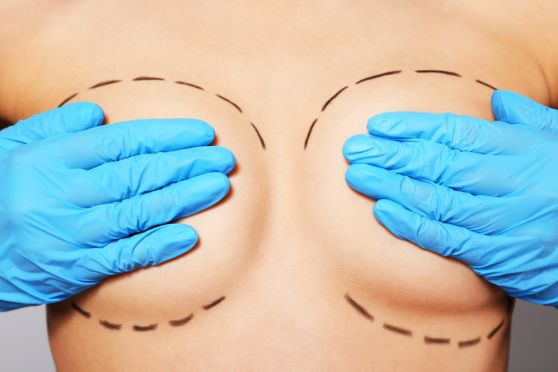 Breast augmentation revision
