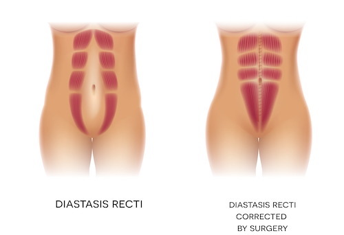 Diastasis recti are separated ab muscles that commonly occur during pregnancy.