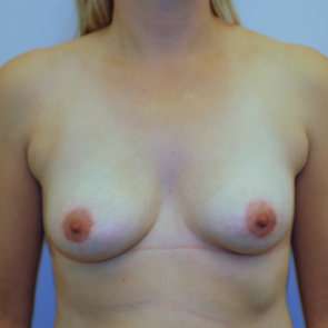 Breast Implant Revision #506