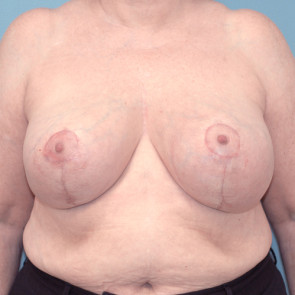 Breast Reduction #1950