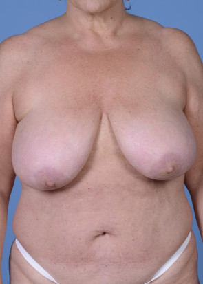 Breast Reduction #604