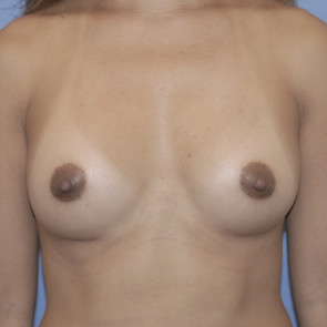 Breast Augmentation #234