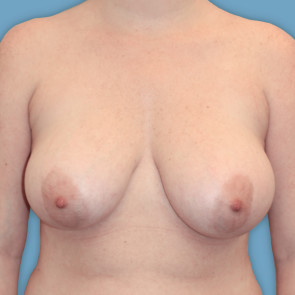 Breast Reduction Case #614