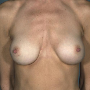 Breast Augmentation #128