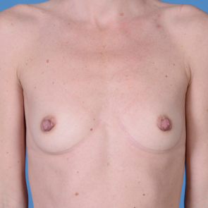 Breast Augmentation #205