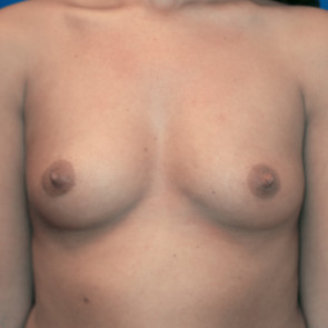 Breast Augmentation #105