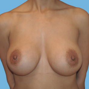 Breast Augmentation #117