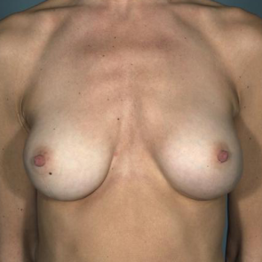 Breast Implant Revision #509