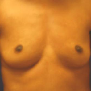 Breast Augmentation #108