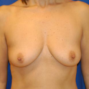 Breast Augmentation #120