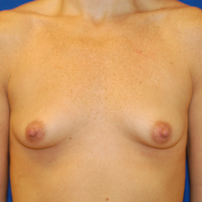 Breast Augmentation #106