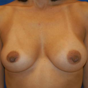 Breast Implant Revision #512