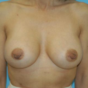 Breast Implant Revision #512