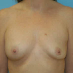 Breast Implant Revision #515