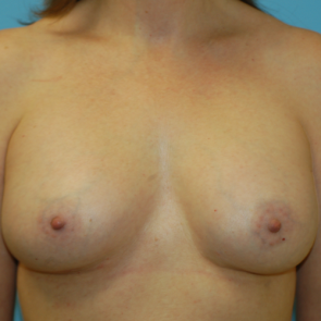 Breast Implant Revision #515