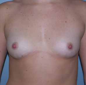 Breast Augmentation #126