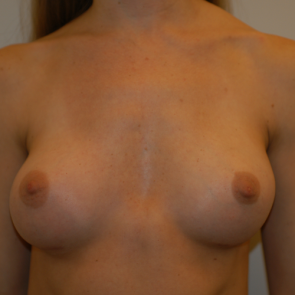 Breast Implant Revision #505