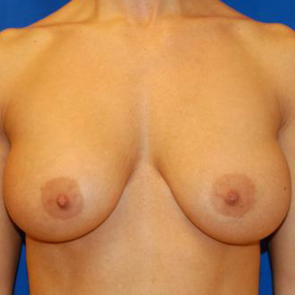 Breast Implant Revision #513