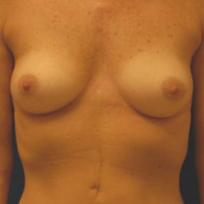 Breast Augmentation #109