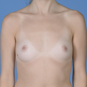 Breast Augmentation #203