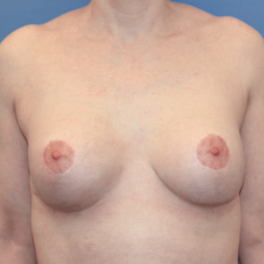 Breast Augmentation #217