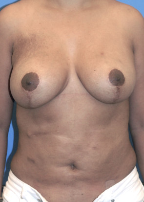 Breast  Augmentation with Lift #804