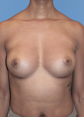 Breast Augmentation #103