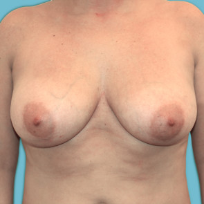 Breast Reduction Case #613