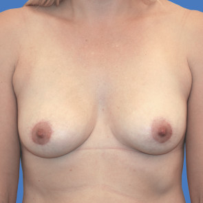 Revision with Shaped Implants CASE # 506