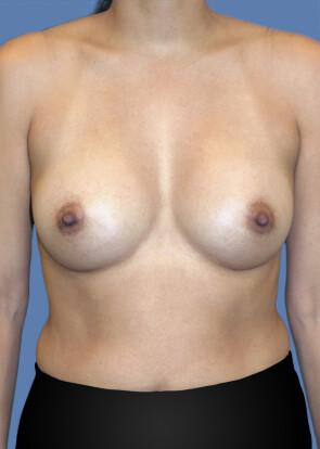 Breast Augmentation Patient #218