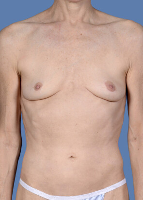 Breast Augmentation Patient #150