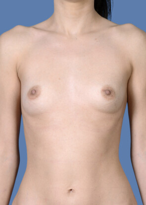 Breast Augmentation Patient #226